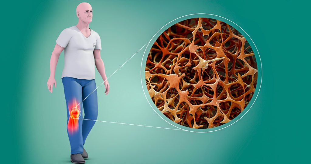 Osteoporose: O que é, causas e tratamentos