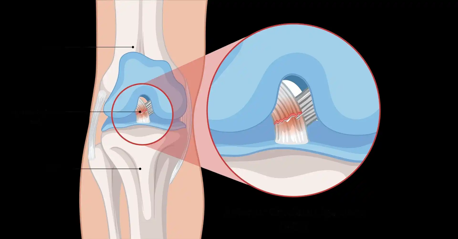 guia pré e pós-operatório de cirurgia dos ligamentos do joelho