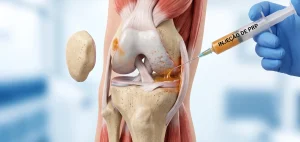 prp | plasma rico em plaquetas